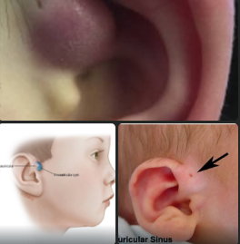 عيان الناسور أمام صيوان الأذن