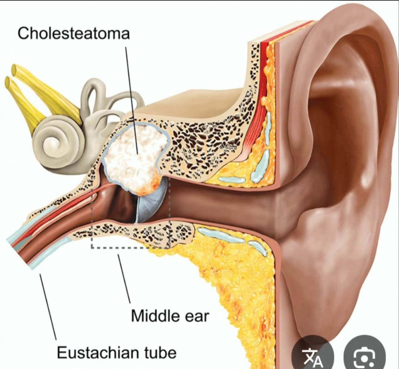 ما هو تسوس الأذن الوسطى؟